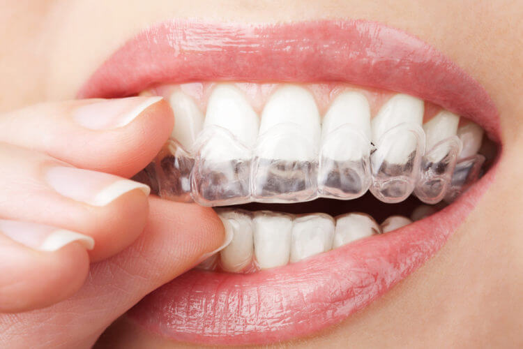 Trindade Odontologia - Aparelho Transparente: Tratamentos.