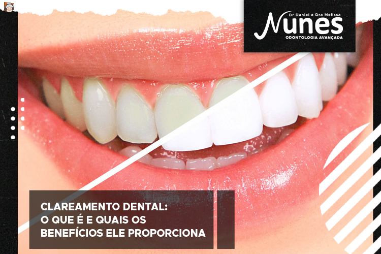 Clareamento Dental