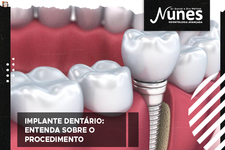 Implante dentário