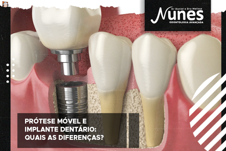 Implante dentário