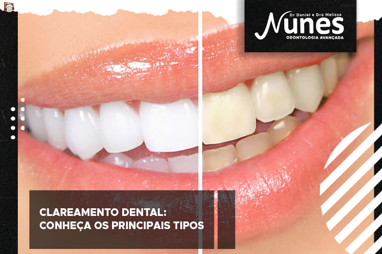 Clareamento dental