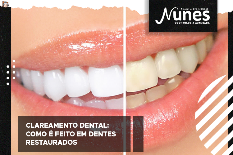 Clareamento dental