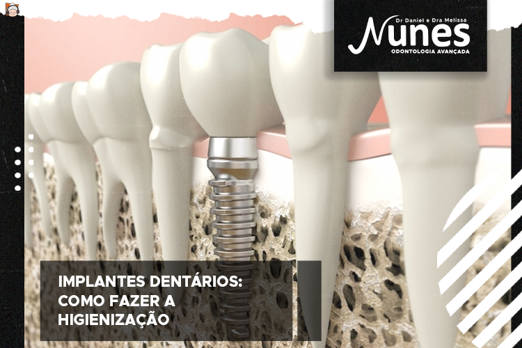 Implante dentário