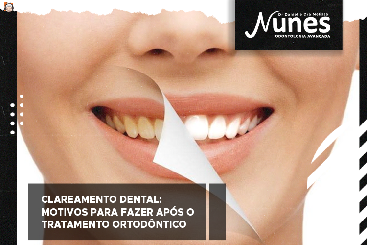 Clareamento dental