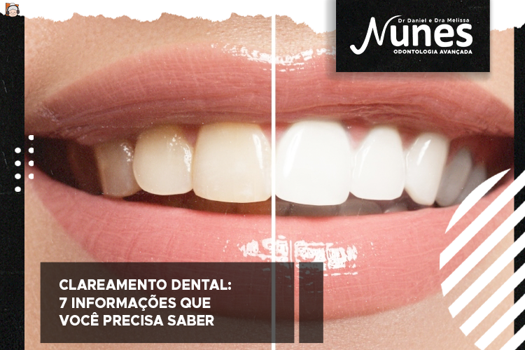 Clareamento dental