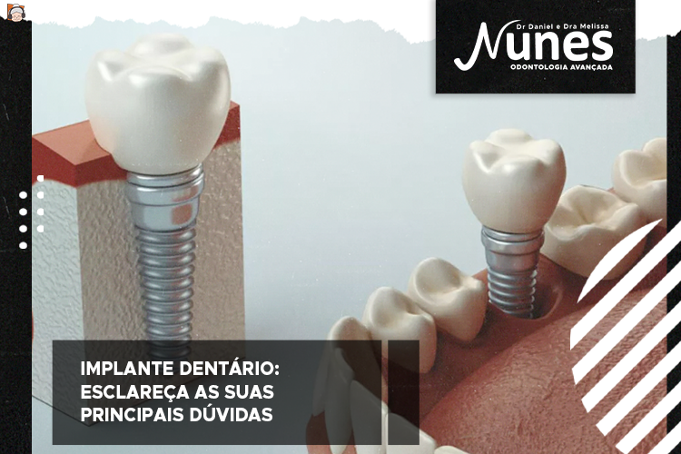 Implante dentário